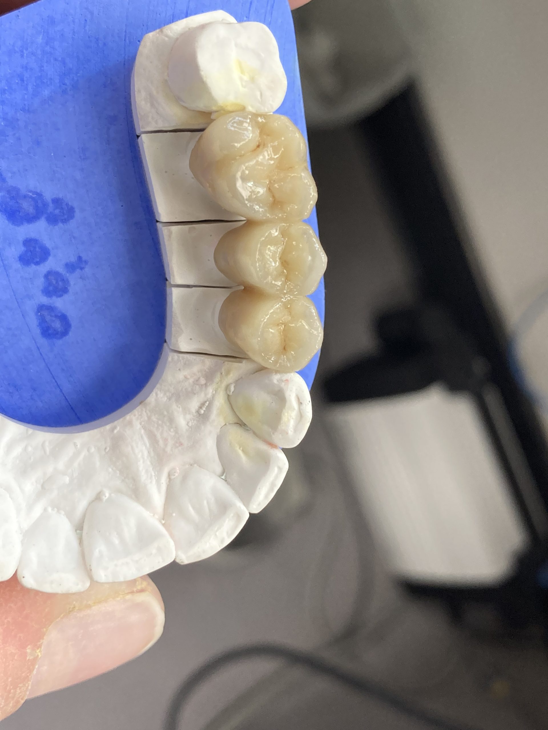 Les Laboratoires Dentaires Gourdy / Prothèses conjointes